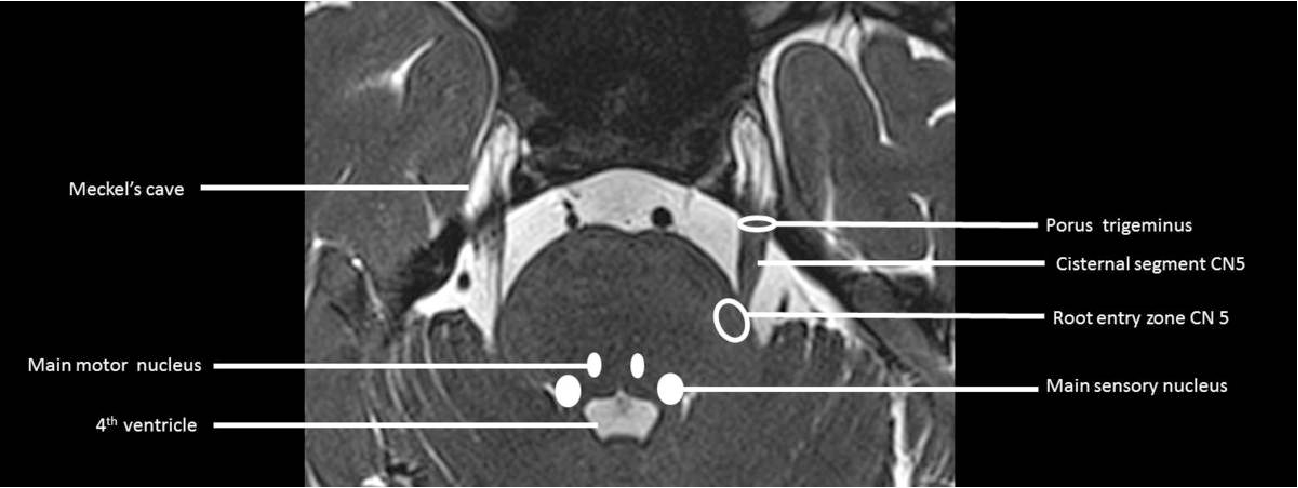 Trigeminal Ganglion Mri