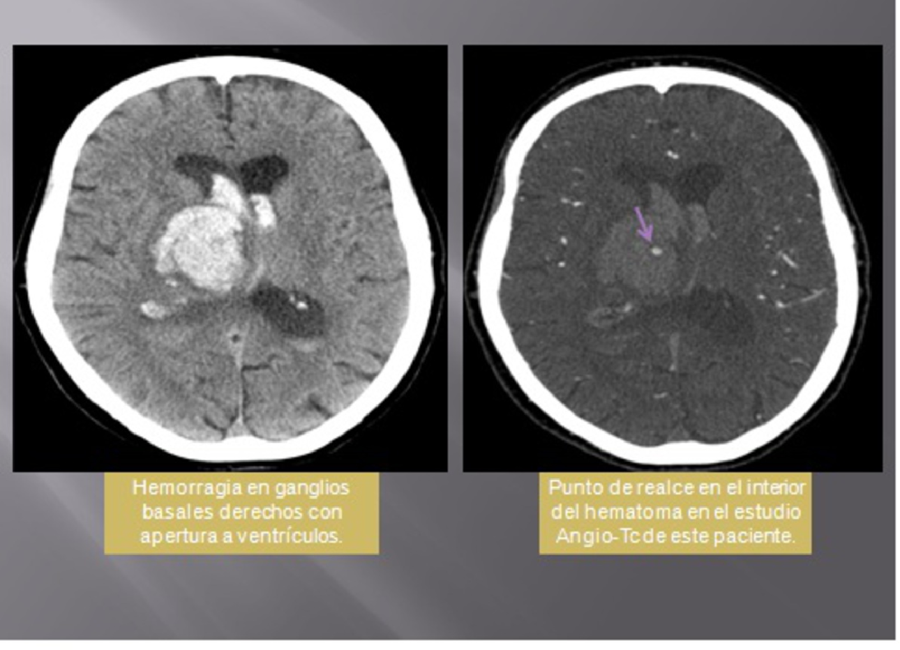 Figure 12 from TC EN LA HEMORRAGIA DE GÁNGLIOS BASALES:Trucos para ...