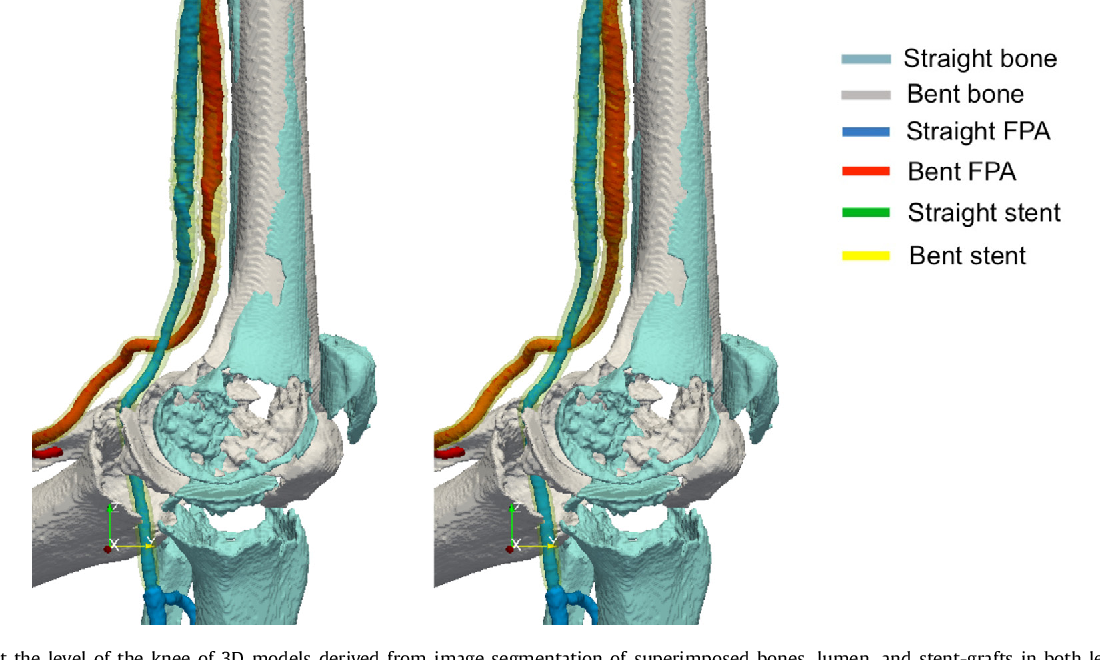 Figure 1 from Patient-specific computational fluid dynamics of femoro ...