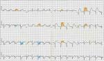 Ecg coloring