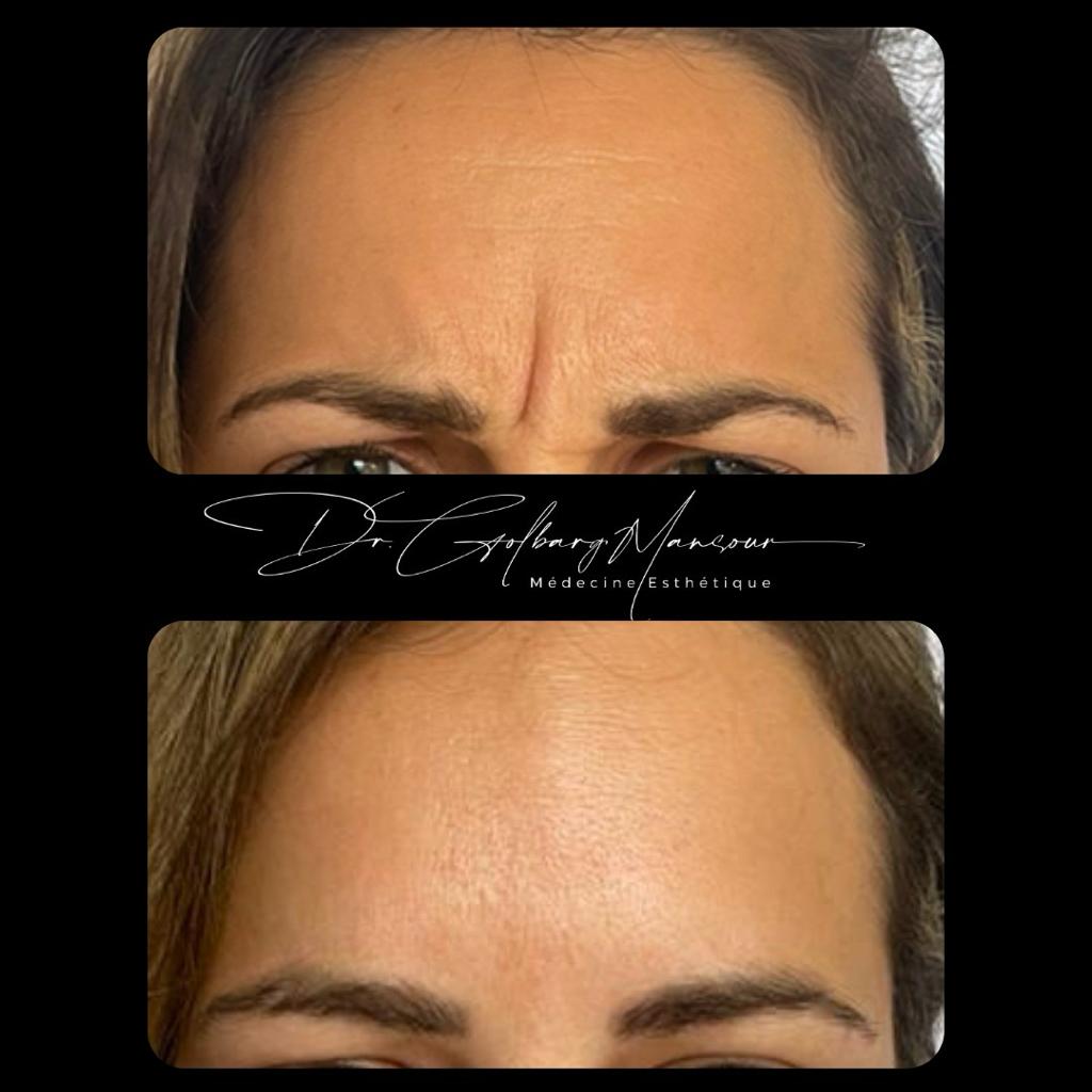 Botox Montreal / before & After Glabella Botox