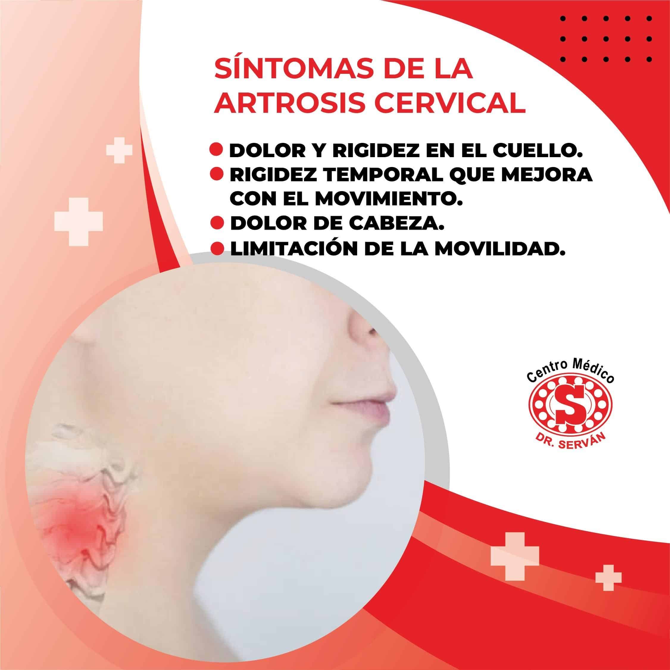 Síntomas de la artrosis cervical – Centro Médico Dr. Serván