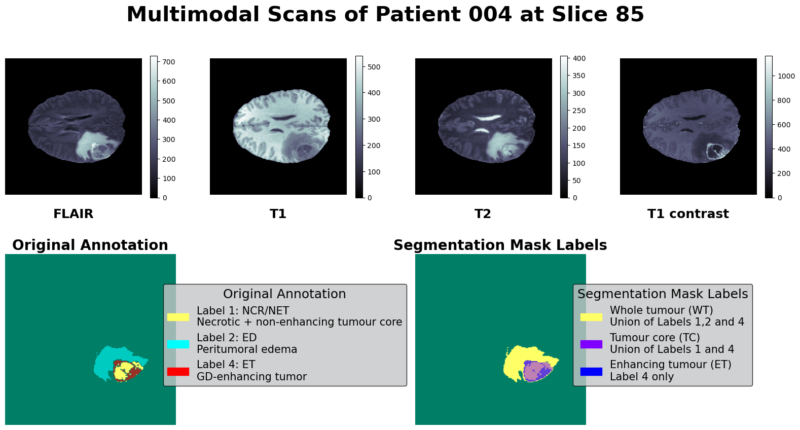 Multi-modal Brain Tumour Scans, original annotations and processed segmentation labels