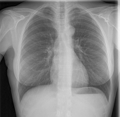 example chest x-ray