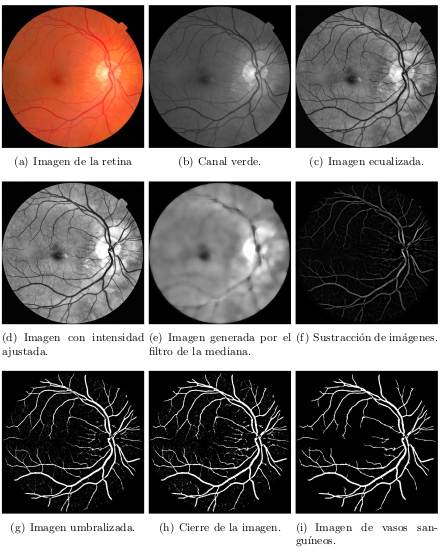 Automatic detection of retinal blood vessels.