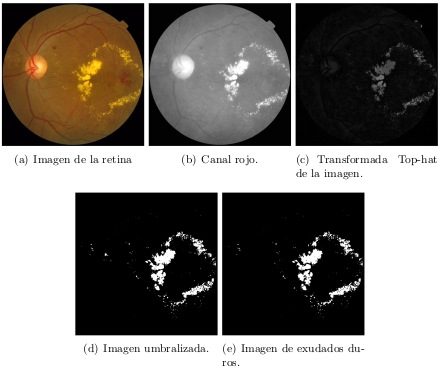 Automatic detection of hard exudates in retinal images.