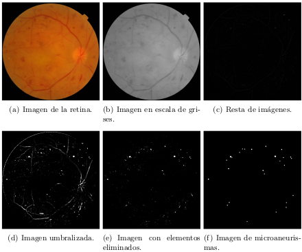 Automatic detection of microaneurysms in retinal images.