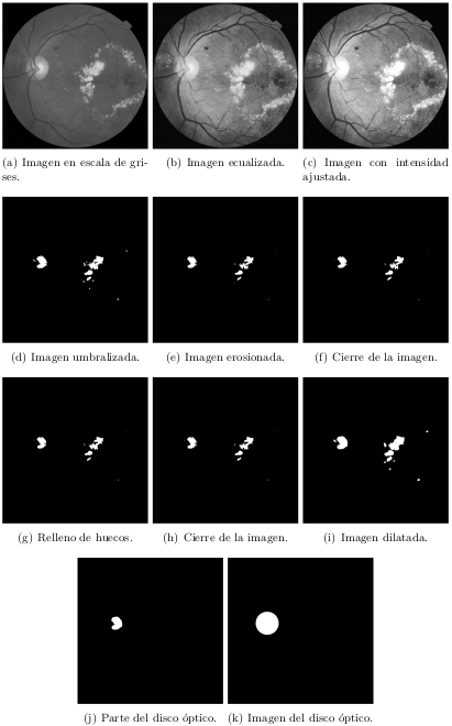 Optic disc detection in retinal fundus images.