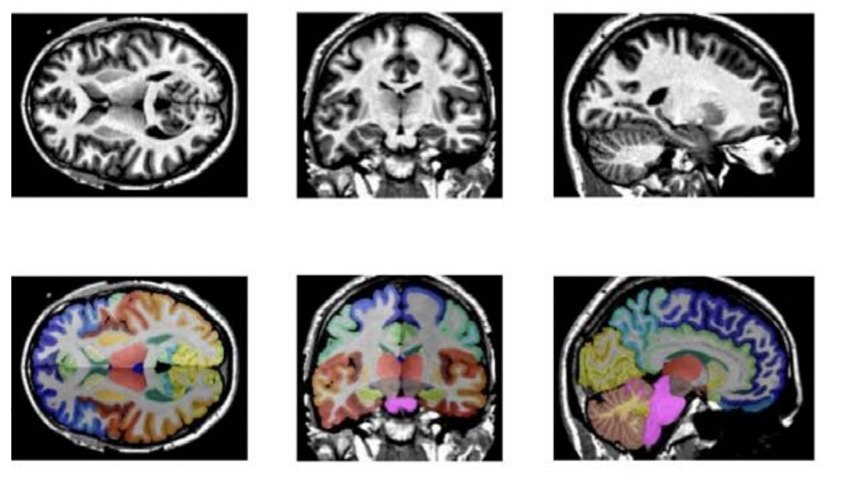 brain_MRI