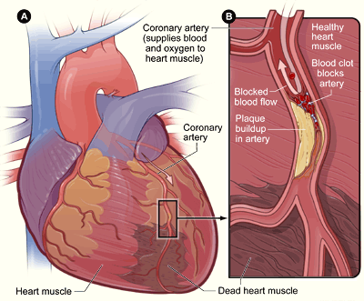 Muerte de células del corazón por una isquemia en las arterias coronarias