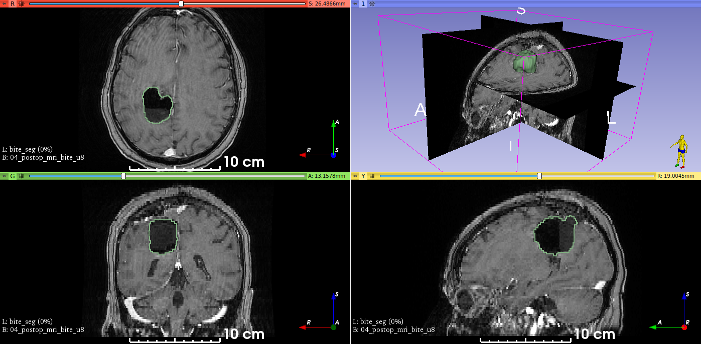 Resection cavity segmented on an image from BITE