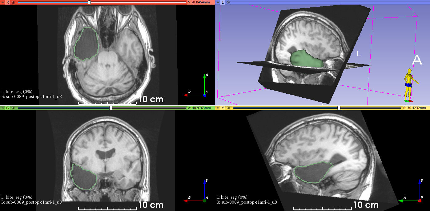 Resection cavity segmented on an image from EPISURG