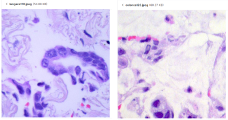 Data Visualization - Lung ACA Sample vs. Colon ACA Sample
