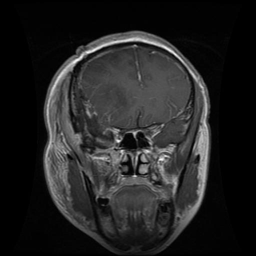 Glioma