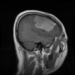 Meningioma