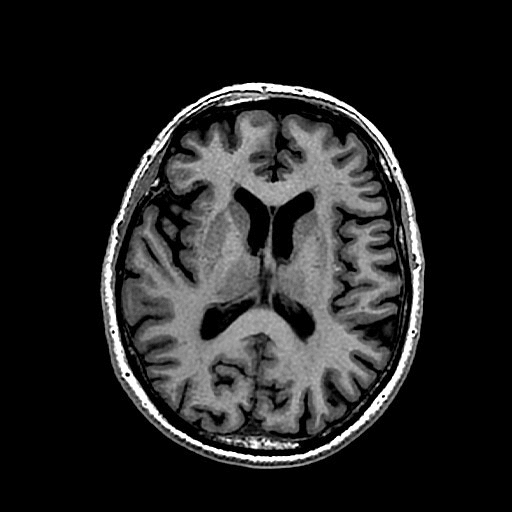 brain image segmenetation