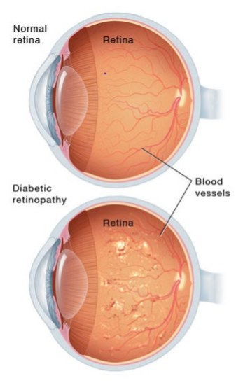 Normal Eye v/s Diabetic Retinopathy Eye