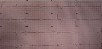 CompleteHeartBlock.jpg