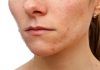 Is There Any New Treatment For Adult Acne?