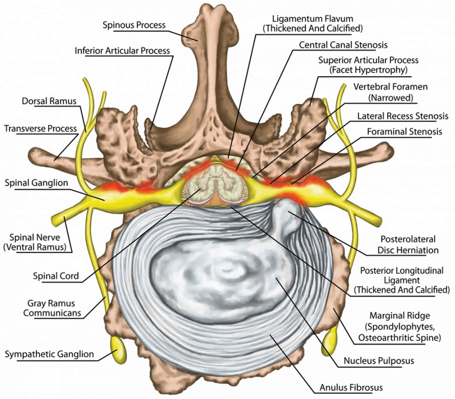 Neural foraminal stenosis causes, symptoms, diagnosis, treatment ...