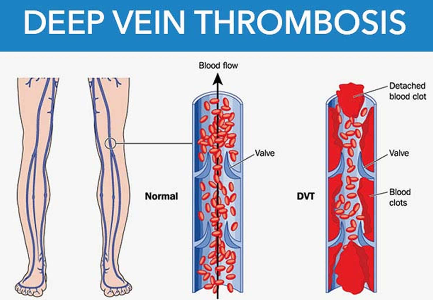 Janusinfo Dvt