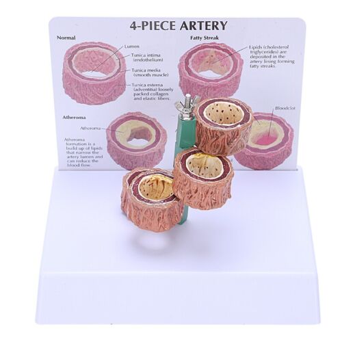 Atherosclerosis Thrombosis Model Vascular Disease Demonstration ...