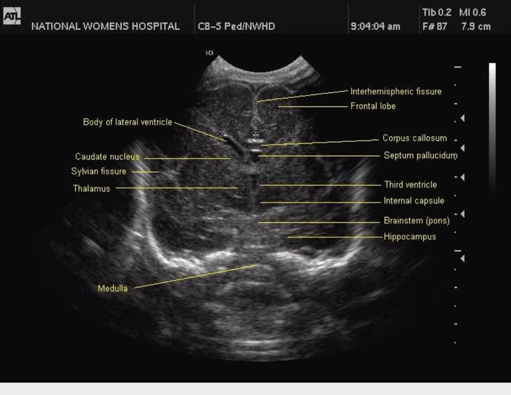 Normal Neonatal Head Ultrasound