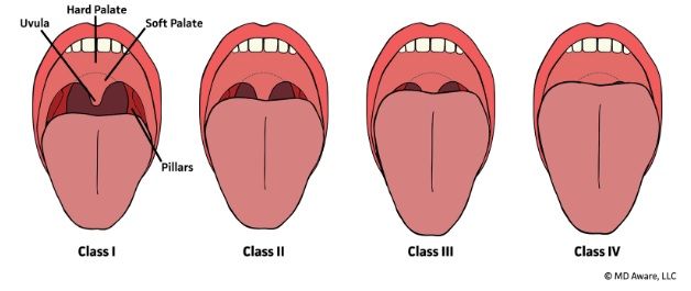 Modified Mallampati Classification | Classification, Modified, Anesthesia