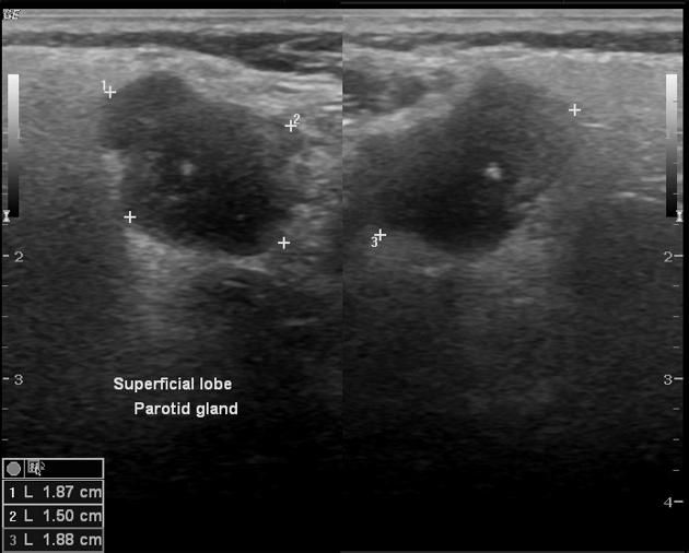 Non Hodgkin's Lymphoma Differential Diagnosis