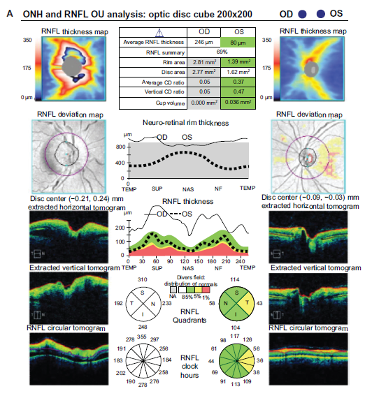 Figure 2 OCT of the optic nerve and macula. (A) Retinal nerve fiber ...