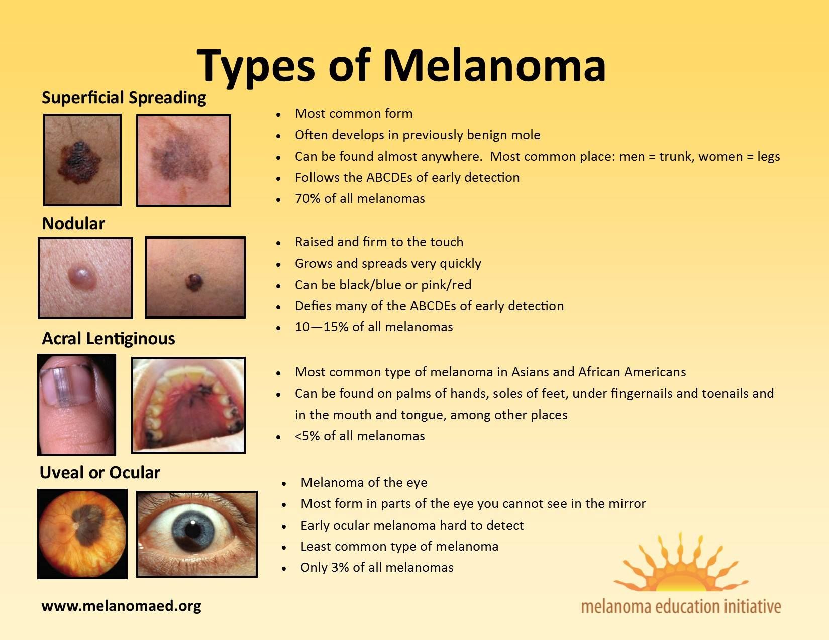 Types of Melanoma. Melanoma education initiative. Melanoma, Women Legs ...