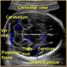 Normal cns ultrasound brain anatomy ob images – Artofit