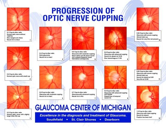 Progression of optic nerve cupping | Eye health facts, Eye facts, Eye ...