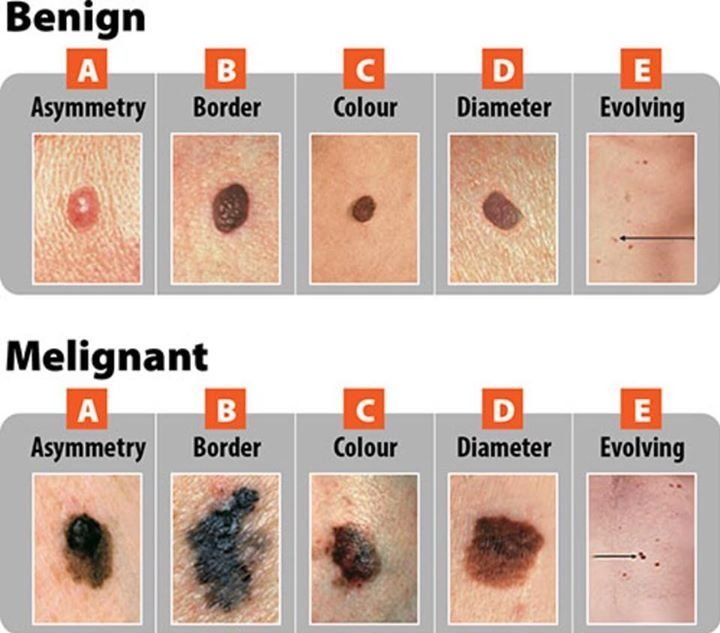 Pin by Dana on Lunares cancerigenos | Skin moles, Skin spots, Cancerous ...