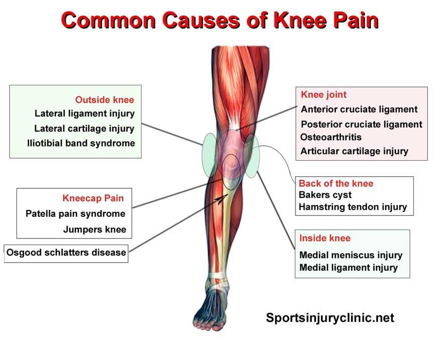 Outer Knee Pain Location Chart