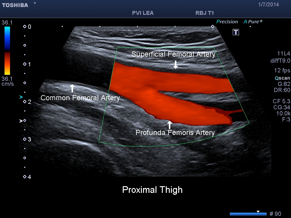 Cardiac Sonography, Sonography Student, Vascular Ultrasound, Ultrasound ...