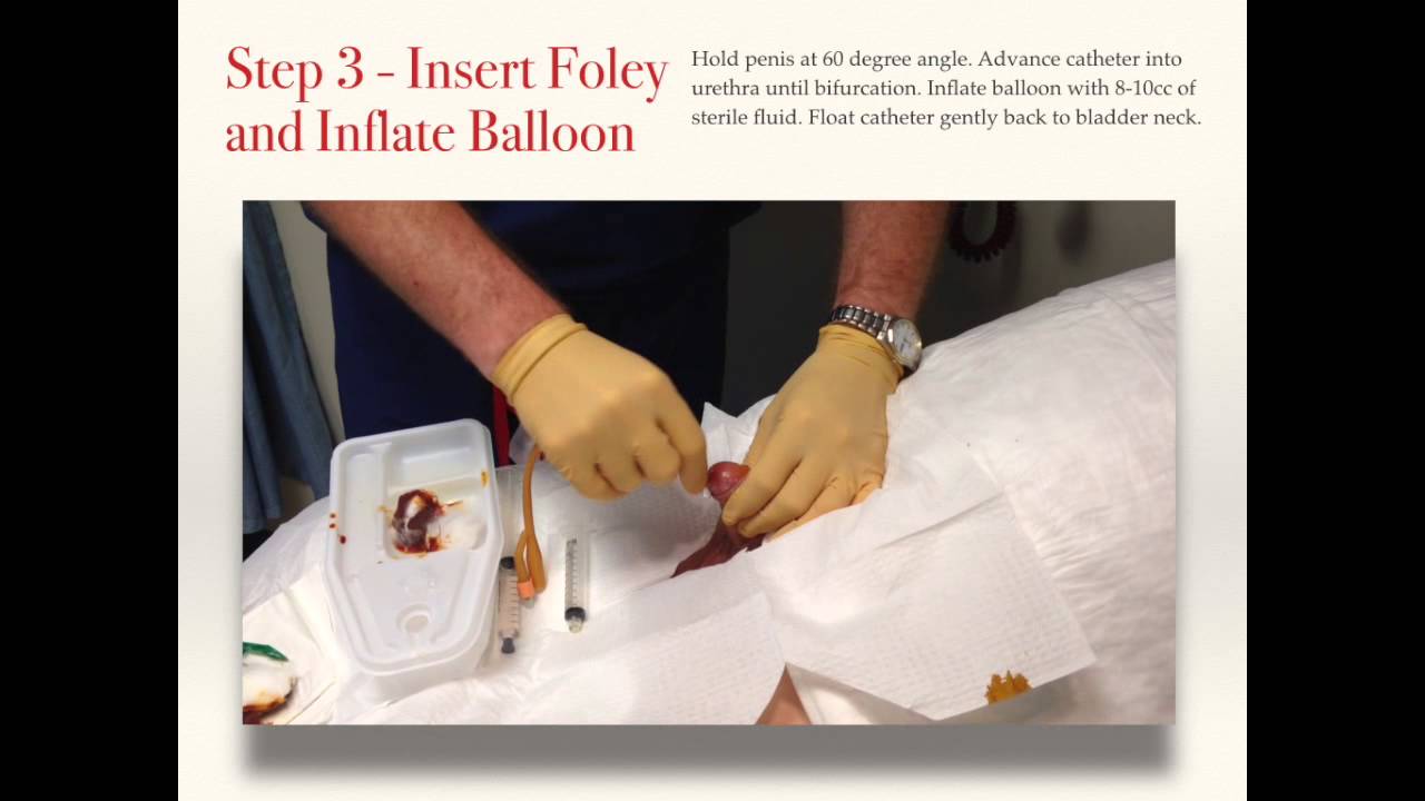 Foley Catheter Insertion Docx Foley Catheter Insertio - vrogue.co