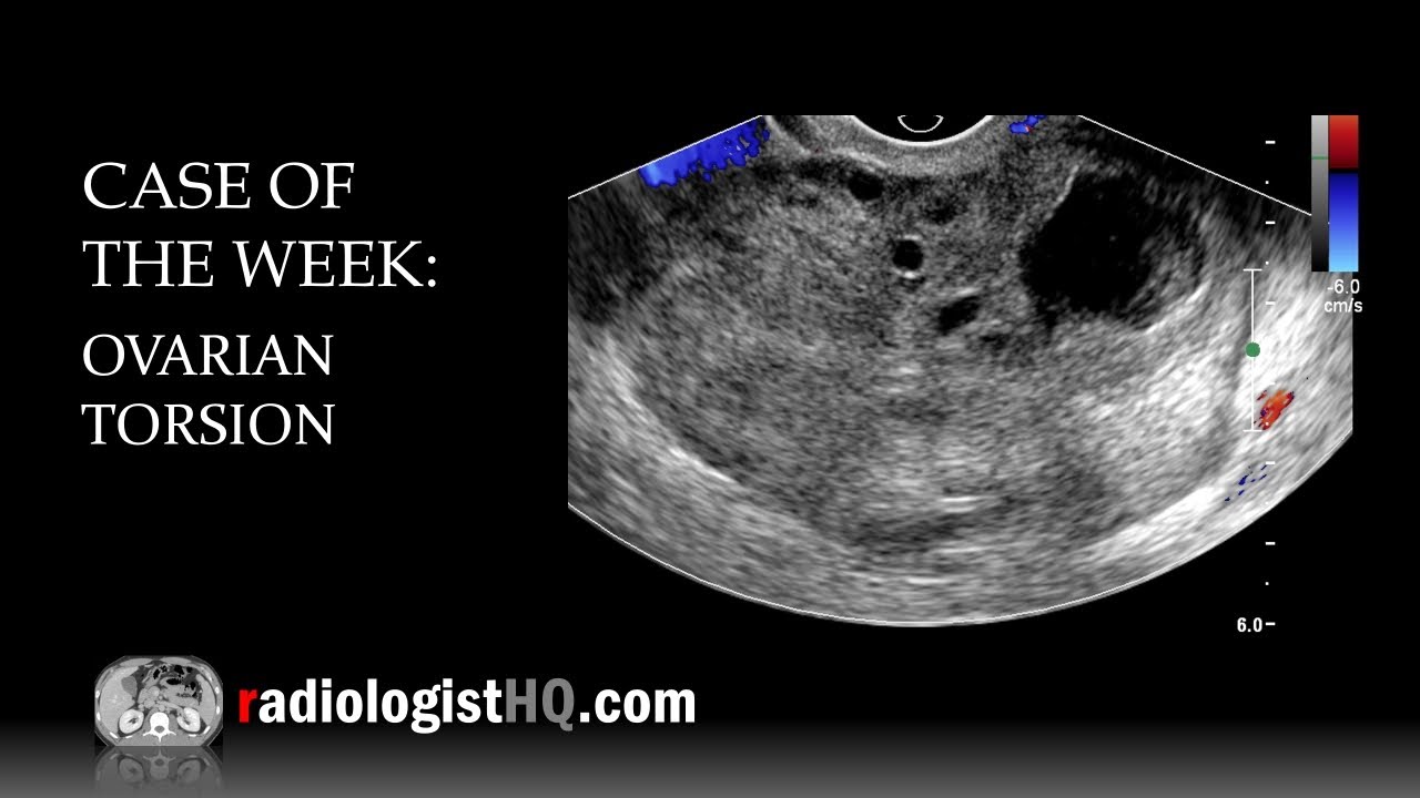 Ovarian Torsion