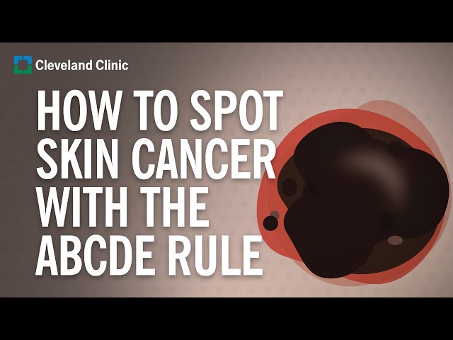 Skin Cancer Signs: A Comprehensive Guide to Early Detection - CancerWalls