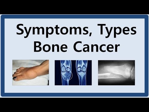 Bone Cancer Symptoms and Types - YouTube