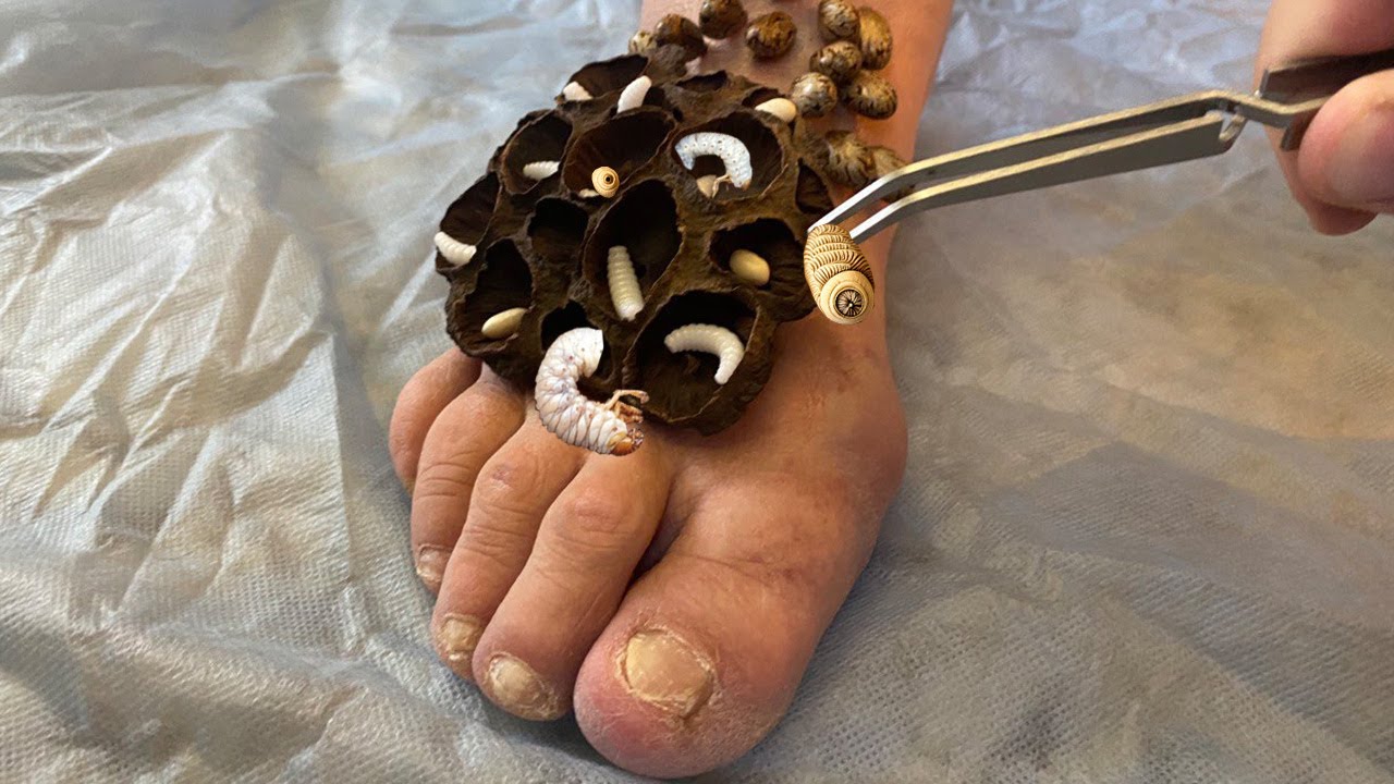 Helped mom save her foot from maggots and trypophobia - YouTube