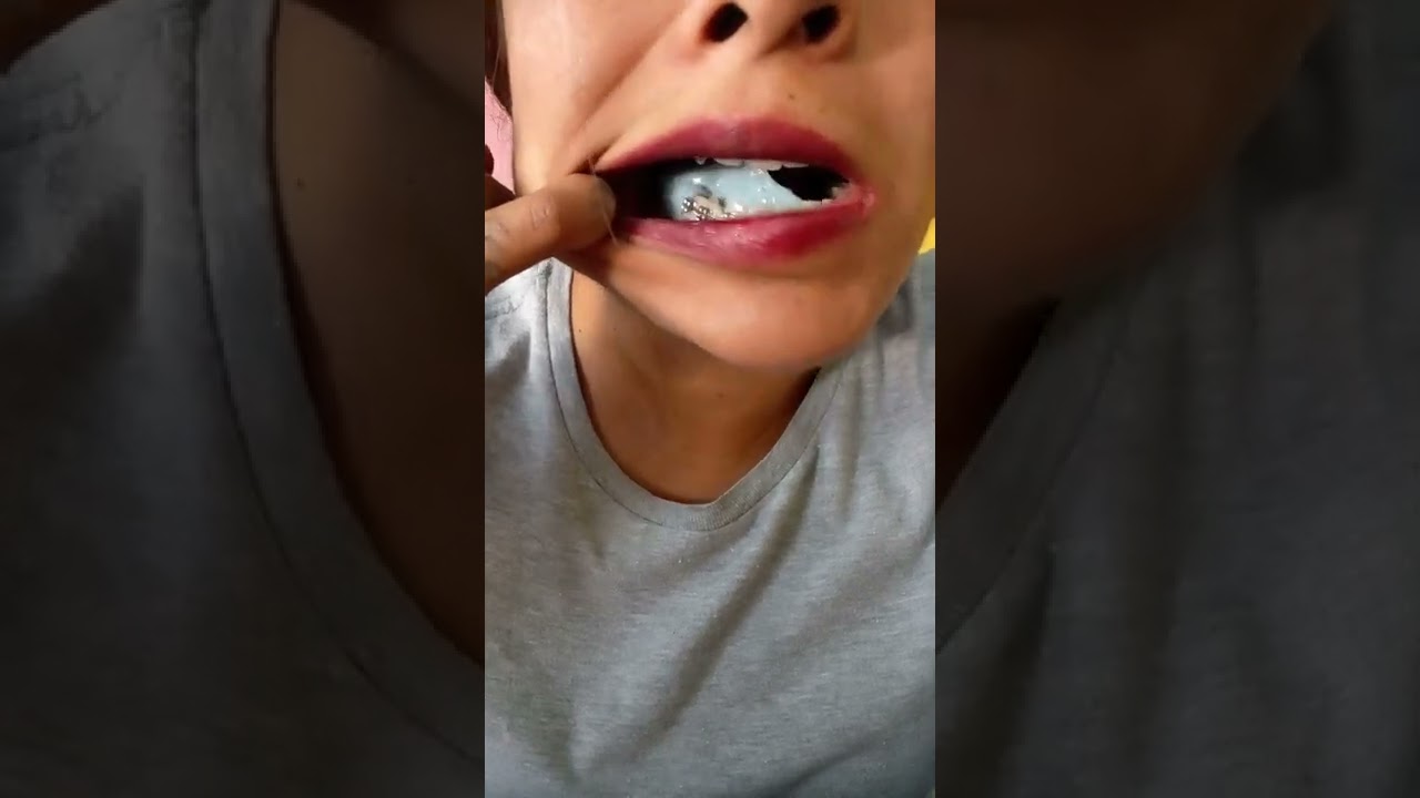 Brackets masticando chicle 😁 - YouTube