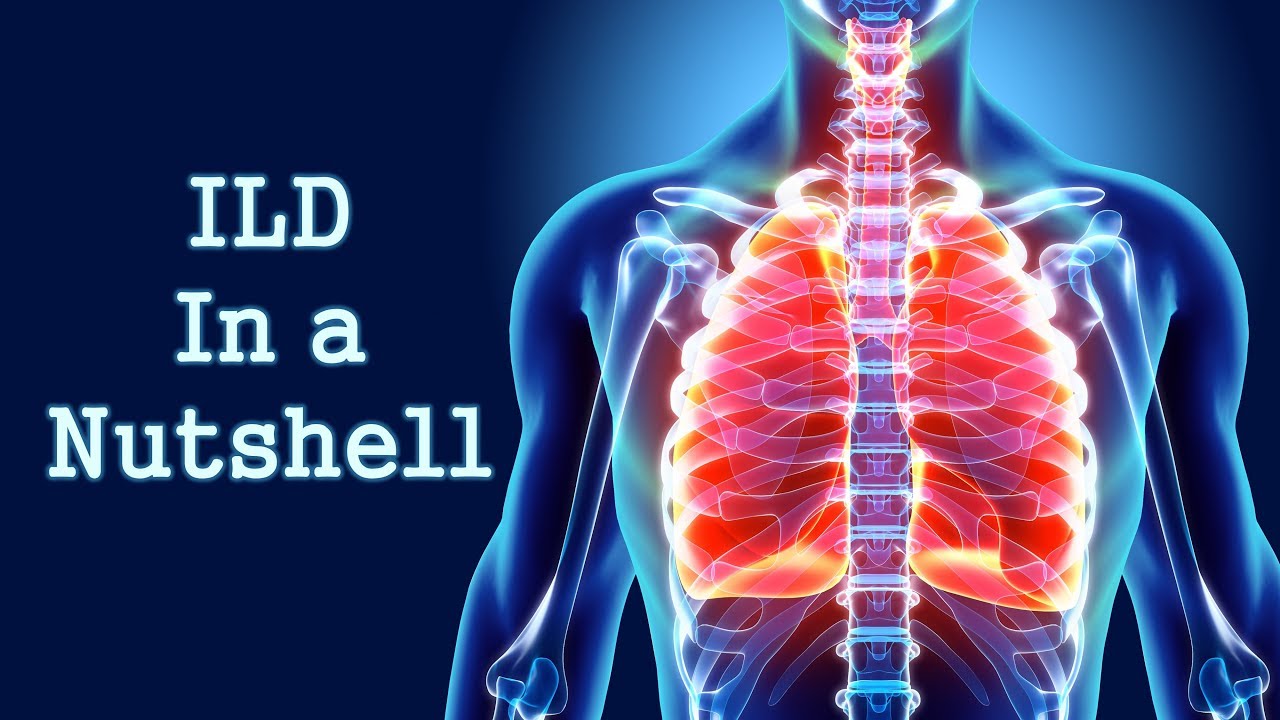 Interstitial Lung Disease X Ray