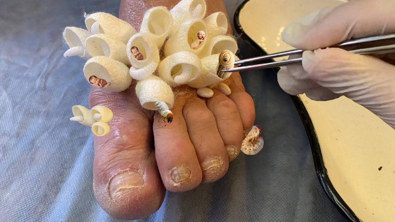 Parasites almost ate this foot - Saved a limb from trypophobia - YouTube