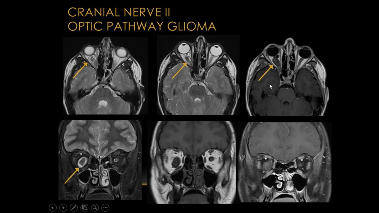 Trigeminal Nerve Mri Sagittal