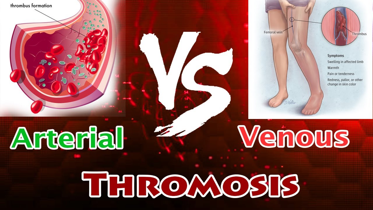 Arterial Thrombosis Vs Venous Thrombosis