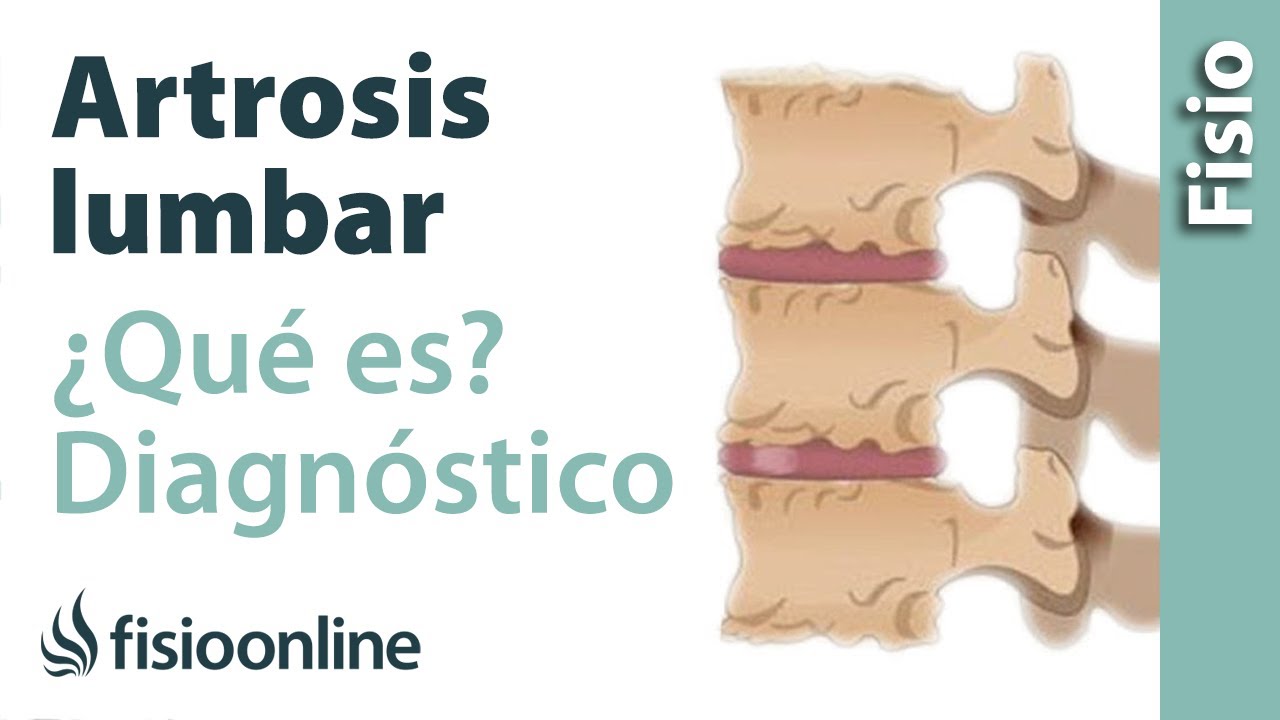 fecha límite Mareo Opcional artrosis de columna vertebral sintomas ...