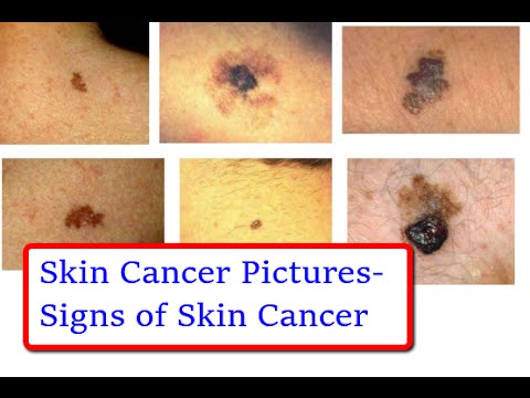 ☞Skin Cancer Pictures - Signs of Skin Cancer in Pictures☜ - YouTube