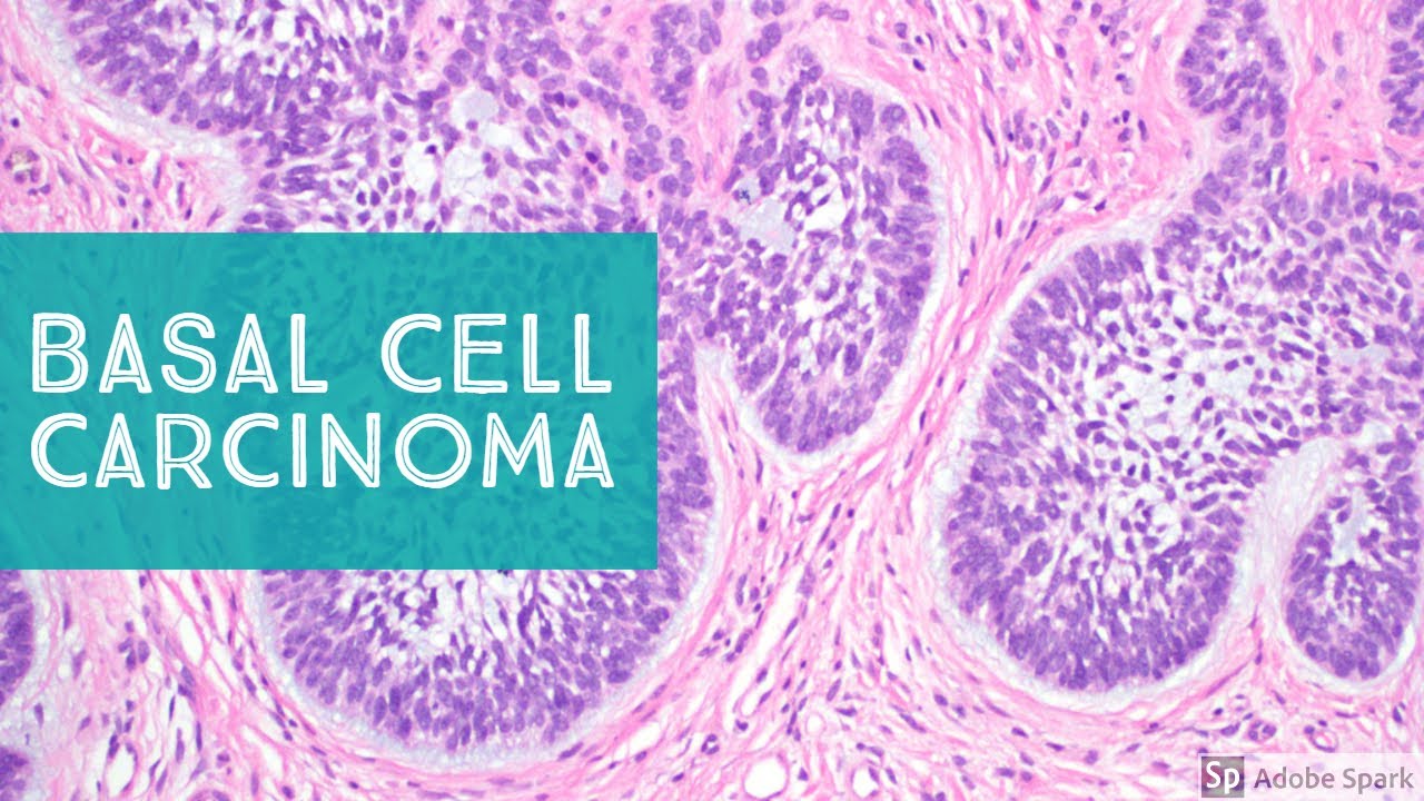 Squamous Cell Carcinoma Vs Basal Cell Carcinoma Histology