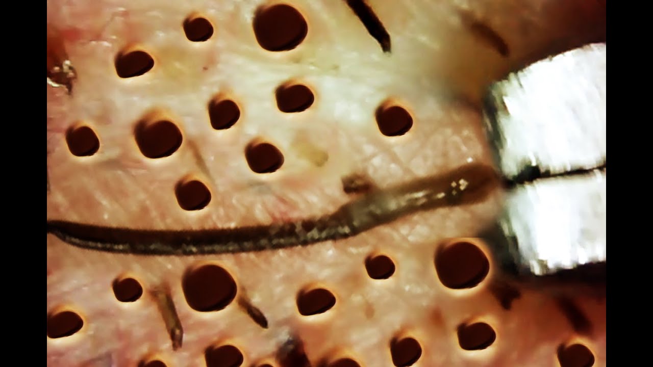 Trypophobia Holes In Eye